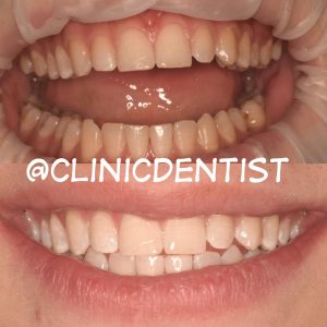 Отбеливание зубов Amazing White США