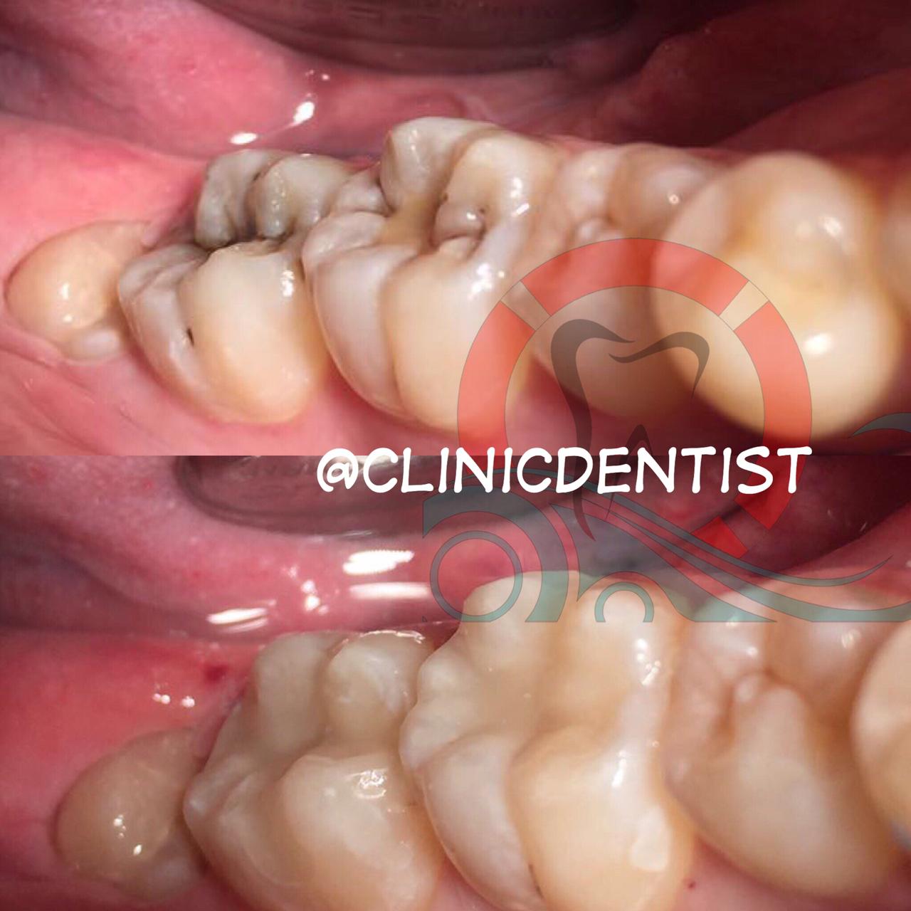 Лечение кариеса в Москве, цены - Стоматологический центр Дент-ИСТ