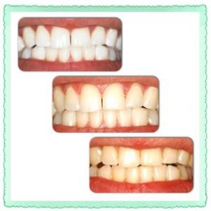 Отбеливание Opalescence