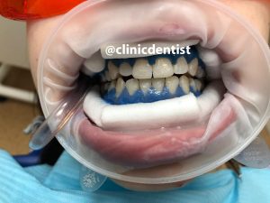 Фотоотбеливание зубов системой Amazing White США