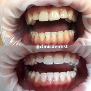 Фотоотбеливание зубов система Amazing White США