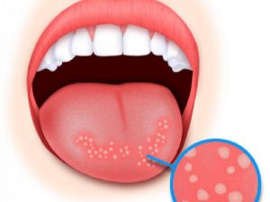 Кандидоз полости рта, что это и чем опасен, как лечить кандидоз — Стоматология Комфорта